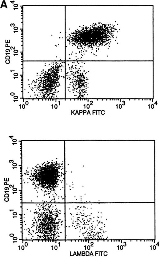 Fig. 3. Flow cytometric histograms showing distribution of CD19/κ and CD19/λ staining. (A) Histograms showing bright monoclonal κ surface Ig expression. (B) Histograms showing dim monoclonal κ surface Ig expression. (C) Histograms showing a mixed monoclonal κ surface Ig expression and polyclonal B cells with a normal κ-to-λ ratio. (D) Histograms showing a B-cell population with dim CD19 and no surface Ig expression.
