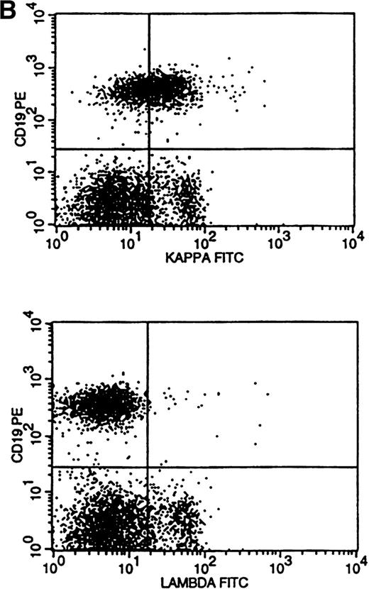 Fig. 3. Flow cytometric histograms showing distribution of CD19/κ and CD19/λ staining. (A) Histograms showing bright monoclonal κ surface Ig expression. (B) Histograms showing dim monoclonal κ surface Ig expression. (C) Histograms showing a mixed monoclonal κ surface Ig expression and polyclonal B cells with a normal κ-to-λ ratio. (D) Histograms showing a B-cell population with dim CD19 and no surface Ig expression.