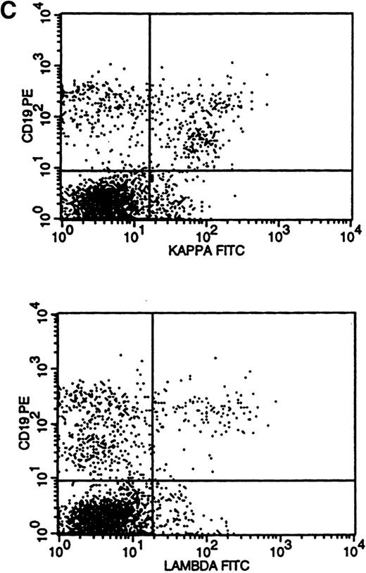 Fig. 3. Flow cytometric histograms showing distribution of CD19/κ and CD19/λ staining. (A) Histograms showing bright monoclonal κ surface Ig expression. (B) Histograms showing dim monoclonal κ surface Ig expression. (C) Histograms showing a mixed monoclonal κ surface Ig expression and polyclonal B cells with a normal κ-to-λ ratio. (D) Histograms showing a B-cell population with dim CD19 and no surface Ig expression.