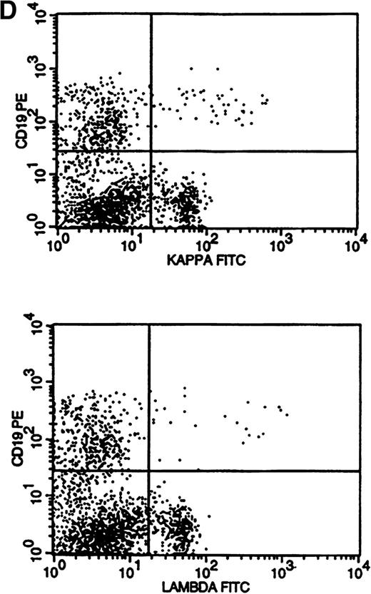 Fig. 3. Flow cytometric histograms showing distribution of CD19/κ and CD19/λ staining. (A) Histograms showing bright monoclonal κ surface Ig expression. (B) Histograms showing dim monoclonal κ surface Ig expression. (C) Histograms showing a mixed monoclonal κ surface Ig expression and polyclonal B cells with a normal κ-to-λ ratio. (D) Histograms showing a B-cell population with dim CD19 and no surface Ig expression.