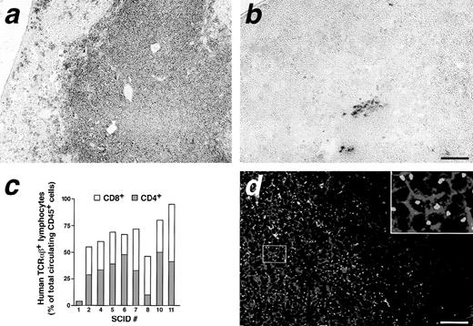Fig. 5. Circulating mature T cells are present in the periphery of CB/Thy-NOD/SCID chimeras. Splenic sections from a CB/Thy-NOD/SCID mouse at 6 months post-CB reconstitution (a) and a control Thy-NOD/SCID mouse (b) stained with an anti-human–specific CD45 MoAb using a peroxidase detection method. Human CD45+ cells occupying the periarteriolar areas are observed in the spleen of CB/Thy-NOD/SCID mouse (a). The brown staining detected in the spleen of the control Thy-NOD/SCID mouse (b) corresponds to the background levels of staining obtained with the isotype control antibody (not shown). The staining is representative of 3 CB/Thy-NOD/SCID and 4 Thy-NOD/SCID chimeras generated in independent experiments. Percentage of human TCR /β+ lymphocytes (c) in the periphery of individual CB/Thy-NOD/SCIDs as detected by flow cytometry of splenocytes or PBL. The proportion of CD4+ (closed bars) and CD8+ (open bars) lymphocytes within the human TCR /β+ population is represented. The NOD/SCID chimeras are numerated as in Fig 1 to allow direct comparison of levels of reconstitution in the BM and thymic compartments. (d) Confocal microscopy of a splenic section from a CB/Thy-NOD/SCID mouse reconstituted with male CB stained by 2-color FISH with human Y chromosome-specific probes (green fluorescence) and anti-CD4 and CD8 MoAbs (red fluorescence). This staining is representative of 3 CB/Thy-NOD/SCID chimeras generated in independent experiments. The inset in (d) shows a magnified detail of Y chromosome-positive cells identified in the spleen. Bar in (a and b) = 125 μm; bar in d = 63.5 μm.