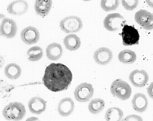 Fig. 1. Blast-forming tenupods in bone marrow aspirate smear of a patient with acute monoblastic leukemia.