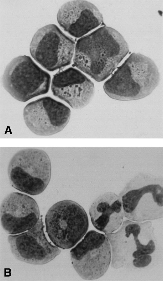 Fig. 4. Cytology of cells proliferated from a single CD34+/Kit+ cell of patients with SCN. Single CD34+/Kit+ cells were cultured in the presence of SF, FL, and, IL-3 with (B) or without (A) G-CSF according to the description in Table 4. Some of the proliferating clones were picked, centrifuged onto a slide, and stained with Wright-Giemsa.