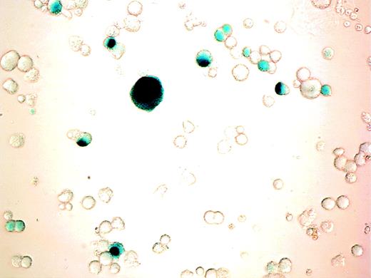 Fig. 4. β-gal expression in cultured cells after adenoviral transduction. CD34+ cells were cultured with PEG-rHuMGDF for 10 days before incubation with AdCNLacZ (MOI of 200). β-gal expression was visualized by light microscopy after cell fixation and X-gal staining as described in Materials and Methods. Photomicrograph of adenovirus infected cells (400×). Note the blue nuclear staining of successfully transduced cells. No blue coloration was detectable in any cell from samples that were similarly stained but were incubated with virus control.