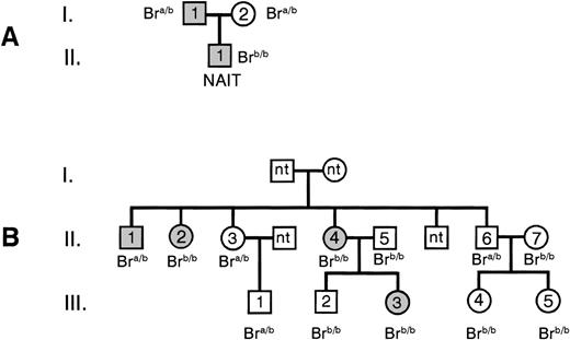 Fig. 2. The pedigrees of the index family Sit (A) and family Dre (B). Solid symbols represent Sita (+), open symbols represent Sita (−) individuals. The child with NAIT is indicated. The Bra and Brb phenotypes of Sita-phenotyped individuals are shown.