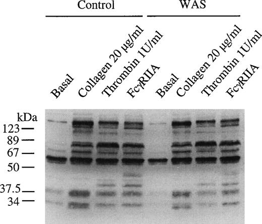Fig. 6. Tyrosine phosphorylation of total cell protein is not altered in WAS platelets. WASp-deficient platelets and control platelets were incubated in Tyrodes-HEPES buffer and stimulated by the addition of collagen (3 μg/mL) for 90 seconds and thrombin (1 U/mL) for 60 seconds and through cross-linking of FcγRIIA for 90 seconds with 1 μg/mL MoAb IV.3 for 60 seconds, followed by the addition of F(ab′)2 (30 μg/mL). Stimulation was stopped by the addition of equal volume of 2× loading buffer. Proteins were separated by 10% SDS-PAGE, electroblotted onto PVDF membranes, and then immunoblotted using the antiphosphotyrosine MoAb 4G10. The same concentration of platelets (1 × 108/mL) was used in samples from the WAS patients and controls. The gel is representative of 2 experiments.