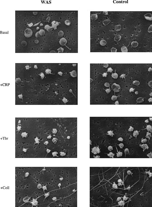 Fig. 7. Formation of filopodia in WASp-deficient platelets. The presence of filopodia on control and platelets stimulated with CRP (5 μg/mL), thrombin (1 U/mL), and collagen (30 μg/mL) from WAS and control donors was assessed by scanning electron microscopy (SEM). Original magnification × 5,200. Results are representative of 6 independently analyzed fields.