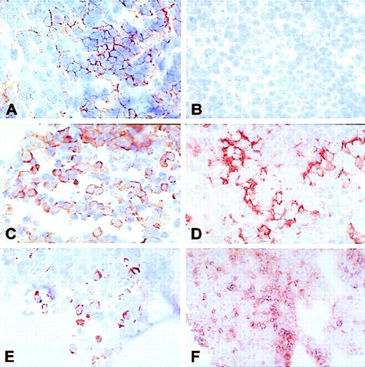 Fig. 1. In situ cytokine expression in LCH biopsies. Single immunohistochemical labeling was used to assess cytokine production in frozen sections of LCH biopsies. (A) IL-1 demonstrated in a positive control tissue sample from human tonsil. Such control tissue was included on each glass slide to internally validate different cytokine stainings (original magnification × 100). (B) Human tonsil: negative control staining using an isotype-matched primary antibody of irrelevant specificity to exclude nonspecific binding of secondary and tertiary step reagents (original magnification × 100).8(C) IL-1–producing cells in a LCH lesion in bone (patient no. S926704). Note the high density of cytokine-expressing cells and the very intense staining of most of the cytoplasm, compared with (B) (original magnification × 100). (D) IL-3–producing cells in a monoostotic lesion (patient no. S9411100; original magnification × 100). (E) IL-10–producing cells in a affected lymph node in disseminated LCH (patient no. S93292). Note that no clustering occurs and that isolated cells display only partially cytokine-filled cytoplasm (original magnification × 100). (F) GM-CSF–producing cells in a monoostotic lesion (patient no. 9408P025; original magnification × 50).