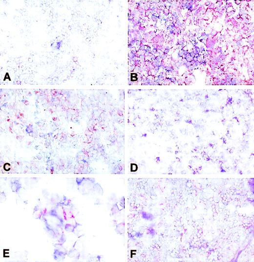 Fig. 2. Identification of cellular origin of cytokines in LCH biopsies. Double immunohistochemical labeling was used to determine cytokine profiles of T cells and LCH cells in frozen sections of LCH biopsies. IL-1 (red) is not produced by CD3+ T cells (blue), as shown by the absence of intermediate (violet) staining (original magnification × 100). (B) In contrast to (A), all CD1a+ LCH cells (blue) also stain for IL-1 (red), resulting in violet double staining (original magnification × 100). (C) IL-5 (red) is not coexpressed with CD1a (blue) and is therefore not produced by LCH cells (original magnification × 100). (D) IL-4 (red)–producing cells stain violet with anti-CD3 (blue) and hence are T cells (original magnification × 100). (E) IFN-γ–producing cells stain in part double (note red, blue, and violet) with CD1a. Because the same was shown in double stainings with anti-CD3, this cytokine is produced by both T cells and LCH cells (original magnification × 200). (F) TNF-–producing cells coexpress CD3 and are therefore identified as T cells (original magnification × 100).