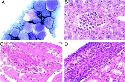 Fig. 5. Identification of lymphoma-like cells in the peritoneal cavity, circulation, and kidney of mice inoculated IP with BCBL-1 cells. (A) Representative cytospin preparation of ascites fluid stained with Diff-Quick showing the presence of large lymphoid cells (original magnification × 1,000). (B and C) Representative peripheral blood smears depicting the presence of large lymphoid cells in the circulation (hematoxylin-eosin stain; original magnification × 400). (D) Representative lymphoma tissue localized under the renal capsule (hematoxylin-eosin stain; original magnification × 200).