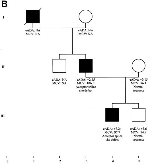 Fig. 6. (A) Transmission of a deletion in exon 1 of RPS19 gene in a family with DBA phenotype and isolated high eADA phenotype. The 4-bp deletion found in the first, noncoding exon of RPS19 gene in the DBA proband IV-3 from family F1 was also found in the mother (III-3) and the grandmother (II-5) who presented only with a high eADA phenotype. Other factors are probably involved in this family, because individual III-4 carries the same deletion, but with a strictly normal phenotype, whereas the deletion could not be found in individual II-11, despite an isolated high eADA phenotype. eADA values are expressed as SD from the mean. NA, not available. (B) Partial segregation of a mutation in a DBA family. The acceptor splice site defect of exon 4 was found in the DBA proband III-4, as well as in his father (II-3) presenting with macrocytic anemia. Erythrocyte ADA value measured in the healthy brother III-5 is between +2 and +3 SD, although he does not carry this mutation. eADA values are expressed as SD from the mean. NA, not available.