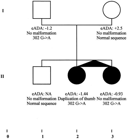 Fig. 7. Cosegregation of a missense mutation of RPS19 gene in a family with various clinical phenotypes in monozygotic twins. A single nucleotide substitution (302 G→A) resulting in an amino acid change of a consensus residue (Arg101His) was found in monozygotic twins (II-2 and II-3) from family I11, with only 1 of them presenting with a duplication of the thumb. The same mutation was also found in the healthy father (I-1), who only exhibited a macrocytosis. eADA values are expressed as SD from the mean. NA, not available.