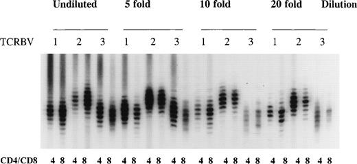 Fig. 1. Method validation of TCR CDR3 size distribution analysis. A cDNA sample of sorted CD4+ and CD8+ T cells from a healthy bone marrow donor was serially diluted to determine the number of cells at which a near normal distribution of TCR CDR3 sizes (8 to 10 bands) in the majority of the TCRBV families could be obtained after a TCRBV-specific spectratype PCR. Shown are the size distributions for undiluted cDNA and a 5-, 10-, and 20-fold dilution representing 30 × 103, 6.0 × 103, 3.0 × 103, and 1.5 × 103 cells in each spectratype for TCRBV1, TCRBV2, and TCRBV3 in CD4+ and CD8+ T-cell subsets.