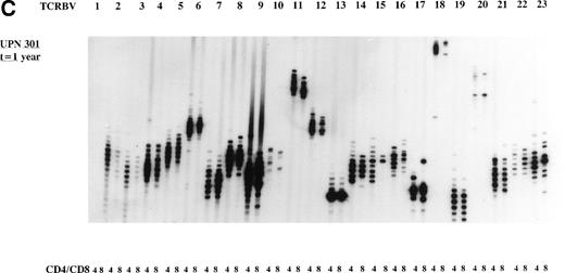 Fig. 2. Representative examples of deviated and normal TCR CDR3 size distributions. (A) Analysis of CDR3 size distribution patterns in UPN 272 at 3 months after allo-BMT in CD4+ and CD8+ T-cell subsets as an example of a deviated/less heterogenous distribution of TCR CDR3 sizes. (B) Similar analysis in UPN 301 at 3 months after allo-BMT in CD4+ and CD8+ T-cell subsets as an example of a less heterogenous/Gaussian distribution of TCR CDR3 sizes. (C) UPN 301 at 1 year after allo-BMT in CD4+ and CD8+ T-cell subsets as an example of a Gaussian distribution of TCR CDR3 sizes. Lanes indicate from left to right TCRBV families (1 through 23).