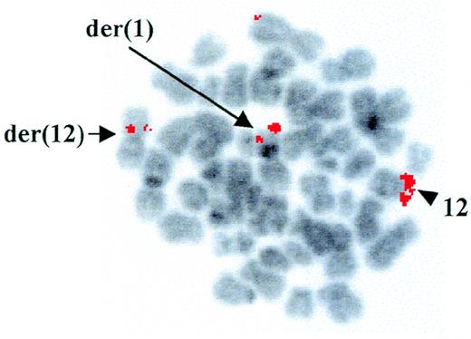 Fig. 1. FISH analysis of the ETV6 rearrangement. FISH with the ETV6-containing YAC 964c10 to leukemic metaphases. Arrows indicate fluorescent signals corresponding to YAC 964c10 on the der(1) and the der(12); the arrowhead shows the normal chromosome 12 homologue. The G-banding on the chromosomes was obtained by inverting the DAPI-counterstained image.