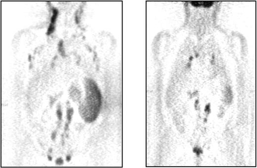 Fig. 1. 18F-FDG PET before and after treatment in a patient with high-grade NHL relapsing 1 month after the18F-FDG PET study. On the left, 18F-FDG PET before treatment: multiple lymph node (cervical, axillary, mediastinal, hilar, iliac, and retroperitoneal) and splenic infiltration. On the right, 18F-FDG PET after treatment: residual18F-FDG uptake in hilar, retroperitoneal lymph nodes, and spleen. The CT scan indicated residual masses in the same areas as18F-FDG PET.