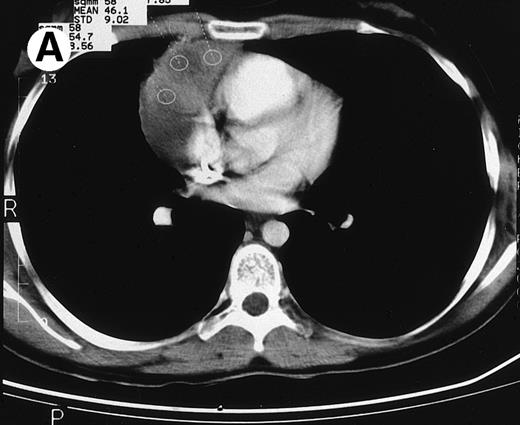 Fig. 2. CT and 18F-FDG PET studies at the end of treatment in a case of relapsed HD remaining in clinical CR after a follow-up of 42 months. (A) The CT study at the end of treatment showed a large residual mediastinal mass. (B) The 18F-FDG PET study of this patient was negative.