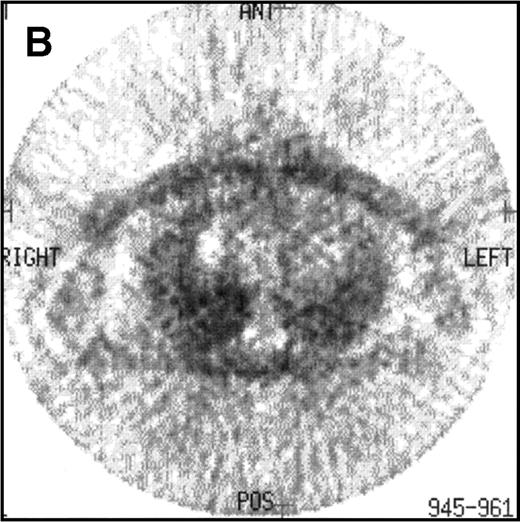 Fig. 2. CT and 18F-FDG PET studies at the end of treatment in a case of relapsed HD remaining in clinical CR after a follow-up of 42 months. (A) The CT study at the end of treatment showed a large residual mediastinal mass. (B) The 18F-FDG PET study of this patient was negative.