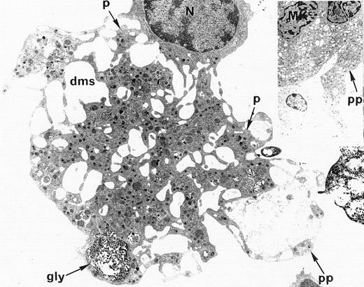 Fig. 4. Electron microscopic view of a cultured mature WAS MK. This MK is starting the process of platelet shedding. The nucleus (N) is excentric, the demarcation membrane system (dms) is widening, delimitating platelet territories (p) and, at the cell periphery, proplatelets (pp) start to extend. (A, -granules; gly, glycogen).M= × 7.375. Insert: Normal proplatelet (pp) extend from mature MK.M= × 2.145.