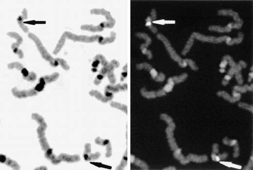 Fig. 4. Determination of the regional assignment of the EPCR gene by FISH. Slides were prepared from phytohemagglutinin-stimulated peripheral-blood cultures and hybridized with biotin labeled PAC DNA. The chromosomes were background-stained with DAPI. The DAPI-banding pattern was enhanced and converted to greyscale with SmartCapture software to enable chromosome and band assignation (left panel). Hybridized PAC DNA was detected using fluorescein isothiocyanate (right panel). Specific fluorescent signals and the locus 20q11.2 are indicated by arrows.