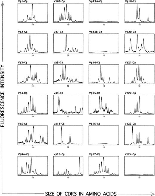 Fig. 4. Analysis of the TCR repertoire expressed by T cells at sites of DTH skin tests with autologous Id. CDR3 size distribution patterns at the level of BV-BC transcripts from a representative MM (UPN 14) are shown. (X-axis) Sizes in amino acids of the CDR3 regions. (Y-axis) Fluorescence intensities, reflecting the number of clones using each CDR3 size combination. The high frequency of abnormal patterns (ie, CDR3 profiles without a Gaussian-like distribution) is indicative of the presence of multiple clonal T-cell populations.
