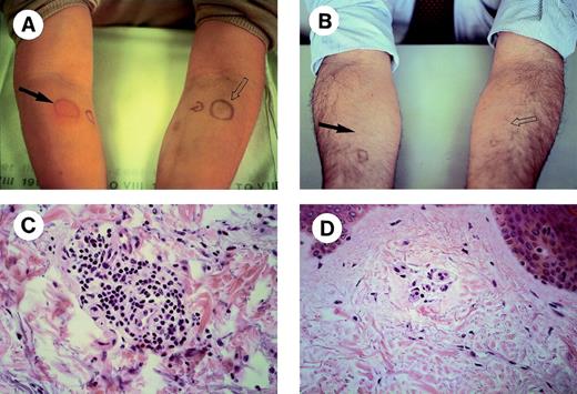 Fig. 1. DTH skin tests in MM receiving Id vaccines. Two representative patients with a positive (A) and a negative (B) reaction are shown. Unconjugated autologous Id alone (solid arrow) or an equivalent amount of polyclonal human Ig as a control (open arrow) were injected intradermally into the opposite forearms. Histologic assessments (original magnification × 40) of skin biopsies taken at sites of autologous Id challenge are shown in (C) and (D).