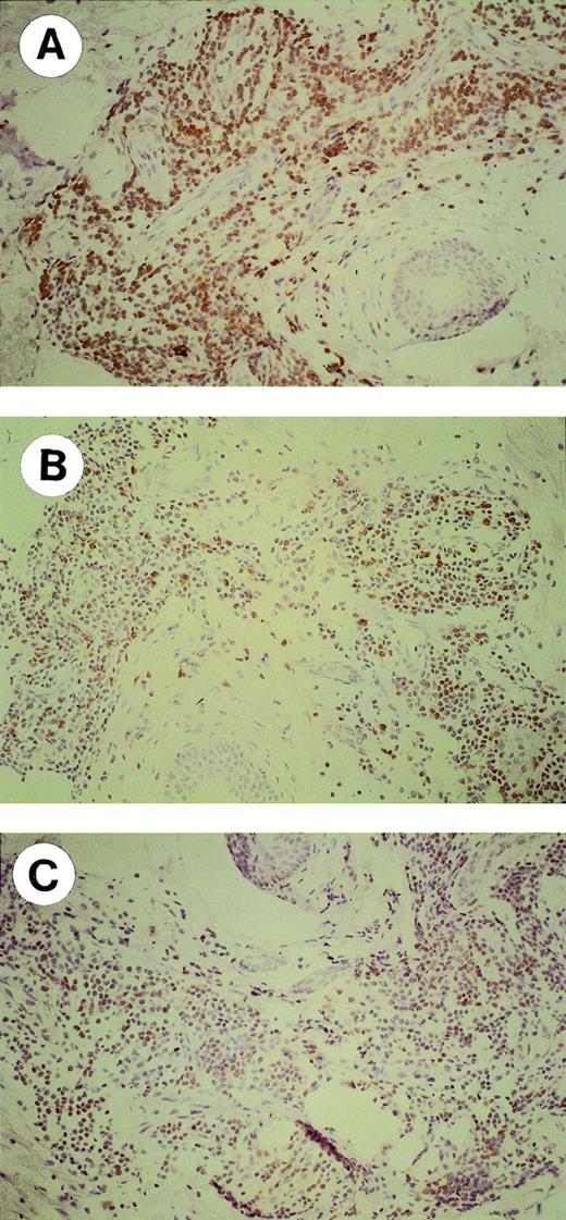 Fig. 2. Immunohistochemical characterization (original magnification × 20) of lymphocytes infiltrating the skin at sites of autologous Id challenge. A representative MM with a positive DTH reaction is shown. Formalin-fixed, paraffin-embedded skin biopsy sections were stained with the following antibodies: (A) polyclonal anti-CD3; (B) OPD4 MoAb (CD4/CD45R0); and (C) C8/144B MoAb (CD8).