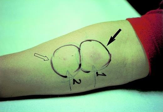 Fig. 3. DTH skin tests with synthetic peptides derived from the VDJ sequence of the tumor-specific Ig heavy chain: CDR3-derived peptide (solid arrow) or an equivalent amount of FR3-derived peptide (open arrow) were injected intradermally side-by-side into the forearm.