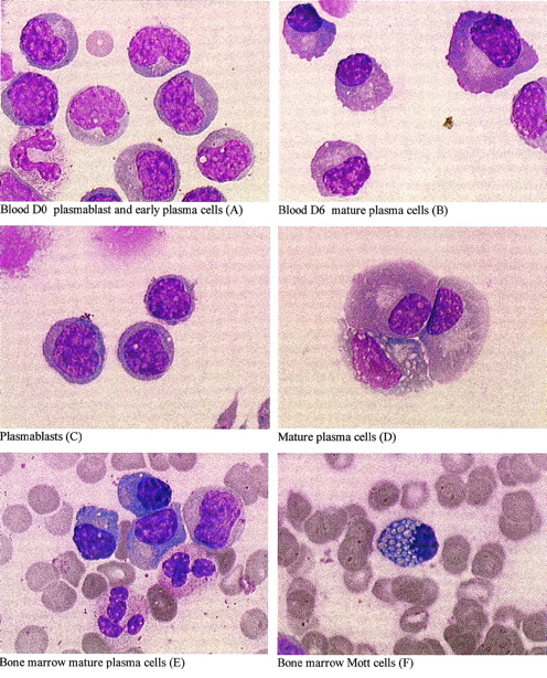 Fig. 3. Plasma cell differentiation in vitro and in vivo. May-Grünwald-Giemsa staining of cell cytospins at day 0 (A and C) or 6 (B and D) from fresh (A and B) or thawed (C and D) PBMNCs or of bone marrow smears (E and F) from patient RP5. From day 0, fresh or thawed PBMNCs were cultured for 6 days in 10% FCS RPMI 1640. After thawing, plasma cells (CD138+) and B cells (CD20+) were removed, as described in Materials and Methods. The CD19+ plasmablastic population (C) accounted for 95% of cells; the remaining cells were T lymphocytes and monocytes. (Original magnification × 1,000.)