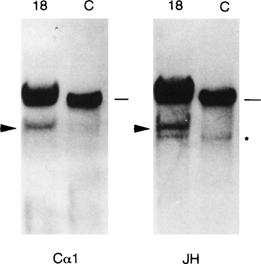 Fig. 5. IGH rearrangement analysis of case no. 18 by Southern blotting. DNA was digested with BamHI restriction enzyme and the same filter was subsequently hybridized with the JH and C1 probe. Comigrating JH- and C-rearranged fragments are indicated by an arrowhead; germ line bands (approximately 18 kb in length) are indicated by a dash. The asterisk shows a JH cross-hybridizing band of approximately 10 kb detectable under our experimental conditions.
