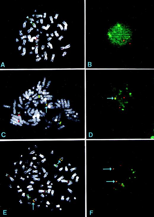 Fig. 2. FISH analyses of normal control and MM-derived cell lines carrying the t(4;14)(p16.3;q32) using the IGH costant regions (green) and the YAC 764-H1 (red) as probes. (A) and (B) Metaphase and interphase nuclei hybridization of normal lymphocytes; arrowheads indicate chromosome 14 and the X indicates chromosome 4. (C) and (D) Metaphase and interphase nuclei hybridization from the KMS-11 cell line. The arrow indicates the colocalized signals on der(14). As shown, the IGH probe recognizes an apparently normal chromosome 14 and an altered, unidentified chromosome; consistent with these findings, there is an additional green signal in the interphase nuclei (D). There are two chromosomes 4 (X) with different long arms; we have previously demonstrated that the longest is the der(4) on the basis of the absence of the FGFR3 locus.13 (E) and (F) Metaphase and interphase nuclei hybridization from the OPM2 cell line. There are two der(14) chromosomes with colocalized signals (arrows). The IGHprobe hybridized to a putative isochromosome and an unidentified, structurally altered chromosome. Three chromosomes 4 were detected (X). Consistent with this pattern, the OPM2 interphase nuclei show five green and five red spots, two of which are overlapping (yellow signal) and indicated by arrows. The FGFR3 locus was found to be localized on both der(14) (data not shown).
