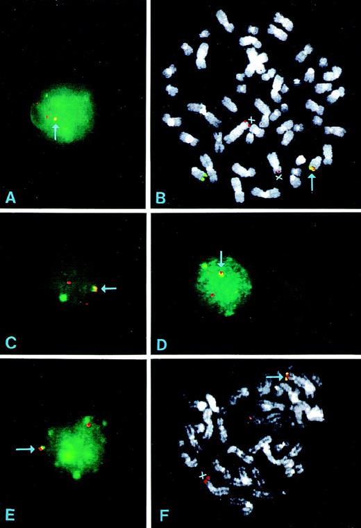 Fig. 3. FISH analysis of MM patients using the IGHconstant regions (green) and the YAC 764-H1 (red) as probes. (A) and (B) Interphase and metaphase nuclei of patient no. 30. The colocalized signals at der(14q) are indicated. YAC 764-H1 recognized two chromosomes 4 on metaphase spreads indicated by X. In one chromosome 4, the signal is faint and consistent with a der(4) chromosome (see text). (C) and (D) Interphase nuclei from cases 9 and 24, respectively. (E) and (F) Interphase and metaphase nuclei of patient no. 18. In this case, the IGH probe is colocalized with YAC 764-H1 on the tip of one chromosome 4p (F); the other chromosome 14q32 is apparently absent, but the second chromosome 4 can be seen (indicated by X).