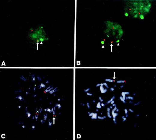 Fig. 4. FISH analysis of MM patients. (A) and (B) Interphase nuclei of patients 24 and 9, respectively, hybridized with the JH (green), YAC 764-H1 (red), and the -satellite chromosome 4 (green) probes. The colocalized JH/YAC signals are indicated by an arrow, and the signals specific for centromeric chromosome 4 sequences by an arrow head. (C) Metaphase from case no. 30 hybridized with the JH (green) and YAC 764-H1 (red) probes. Colocalized signals at the putative der(4) chromosome are indicated by an arrow, and der(14) by X. (D) Metaphase from case no. 18 hybridized with the JH (green) and YAC 764-H1 (red) probes. The colocalized signals on the telomeric region of chromosome 4p are indicated by an arrow.