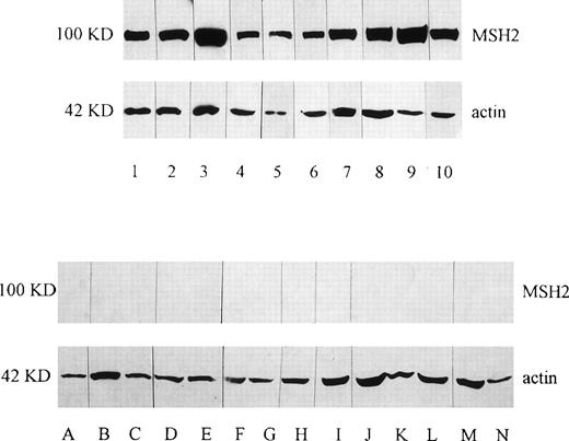 Fig. 1. Western blotting analysis of MSH2 protein in leukemic cells. Thirty micrograms of protein was loaded per lane and blotted with either anti-MSH2 antibody or anti-actin antibody as a control. In the upper panel, the expression of MSH2 protein was shown in the patients from left to right: 1 (JH), 2 (MD), 3 (WA), 4 (CA), 5 (DC), 6 (SR), 7 (PN), 8 (DG), 9 (MC), and 10 (PS). In the lower panel, no MSH2 protein was shown in the patients from left to right A (EH), B (EW), C (KP), D (JG), E (MJ), F (MP), G (GMT), H (MT), I (NS), J (RG), K (SG), L (AH),M(AS), and N (BG). The expression of actin as a control was shown in all of these patients.