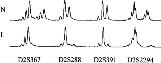 Fig. 3. Detection of LOH at 4 markers located in 2p22-21. The upper one was normal T cells (N). The lower one was leukemic cells (L). LOH was shown in all of 4 markers.