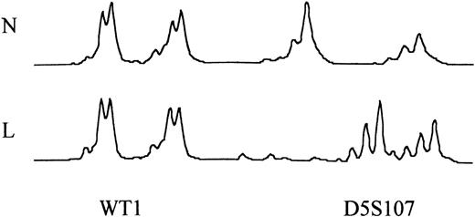 Fig. 5. Microsatellite analysis comparing normal (N) T-cell and leukemic (L) DNA at the WT1 locus in patient MRT and the D5S107 locus in patient EW. In patient MRT, there was no evidence of MSI. In patient EW, MSI was seen as a shift in the size of the PCR product.