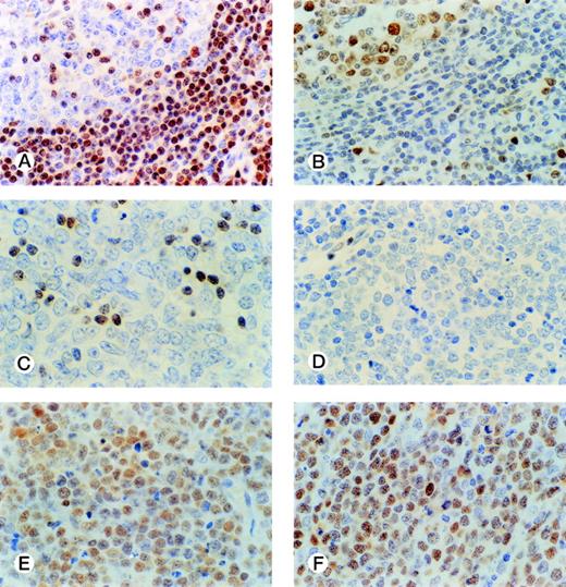 Fig. 1. p27 and cyclin D3 expression in reactive and tumor lymphoid tissue. Germinal center cells show low levels of p27 expression (A) with opposed high cyclin D3 staining (B). DLBCL case with a low level of p27 expression restricted to small lymphocytes (C); and cyclin D3–negative (D). DLBCL case with high simultaneous expression of p27 (E) and cyclin D3 (F) in tumor cells.