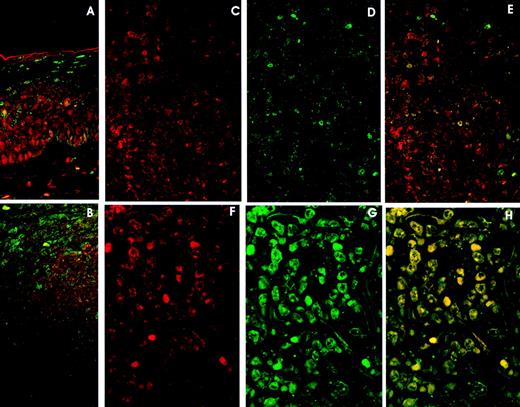 Fig. 4. Double immunolabelling and LSCM studies. A and B. Reactive Lymphoid Tissue. (A) Tonsil surface epithelium: cyclin D3 expression (red) in the lower 23rds and p27 expression (green) in the upper third. Cyclin D3 and p27 colocalization (yellow) is very unusual. (B) Tonsil reactive follicle showing cyclin D3 expression (red) mainly restricted to germinal center cells and p27 expression in mantle cells and very few germinal center cells (green). Cyclin D3 and p27 colocalization is very infrequent (yellow). C, D, and E. DLBCL with high (60%) cyclin D3 expression (red) (C) and moderate (20%) p27 expression (green) (D). Cyclin D3 and p27 colocalization (E) (yellow) is observed in isolated cells. F, G, and H. DLBCL with (F) high (79%) cyclin D3 expression and (G) p27 overexpression (85%). Cyclin D3 and p27 colocalization (H) occurs in almost every cell.