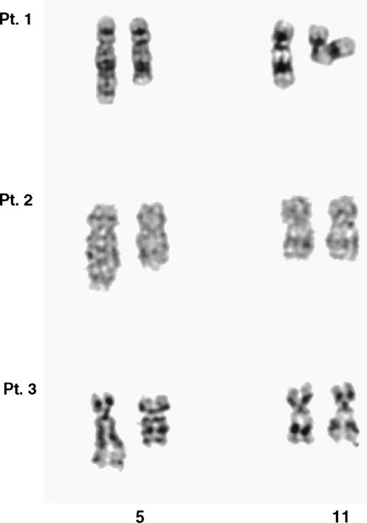 Fig. 2. Partial G-banded karyotype of the chromosomes 5 and 11 from the 3 t(5;11) patients. In each case, the der(5) is shown on the right. It was not possible to unequivocally identify the der(11) in any of the 3 cases.