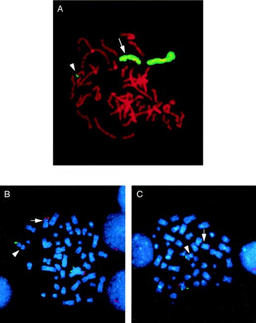 Fig. 1. Identification of a cryptic t(5;11) by whole chromosome painting and FISH with subtelomeric probes. (A) The whole chromosome 5 paint highlights the normal chromosome 5 homologue, the del(5q) (arrow), and the tip of an apparently normal chromosome 11 (arrowhead) in a metaphase from patient no. 3. Subtelomeric probes for 5p, 5q (B) and 11p, 11q (C) confirm the t(5;11) in metaphases from patient no. 2. In each case, the p arm subtelomeric probe is detected in Texas Red (red fluorescent signal) and the q arm subtelomeric probe is detected in fluorescein (green fluorescent signal). In both cases, the normal chromosome homologue has fluorescent signal corresponding to both the p and q arm subtelomeric probes. In (B), the del(5q) has only the p arm signal present (arrow), with the 5q subtelomeric probe present on the the short arm of the der(11) (arrowhead). Similarly, in (C), the der(11) (arrowhead) shows only the q arm signal, with the 11p subtelomeric probe sequences present on the del(5q) (arrow).