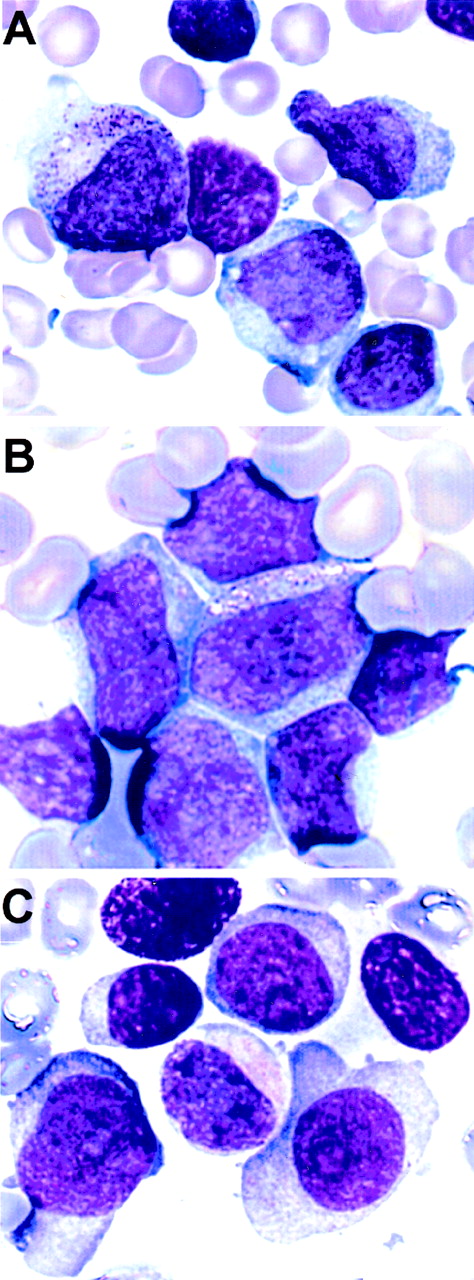 Fig. 3. Morphology of the leukemic blasts from the 3 patients with a t(5;11). (A) Patient no. 1, bone marrow, AML-M2. (B) Patient no. 2, peripheral blood, AML-M4. (C) Patient no. 3, bone marrow, AML-M2.