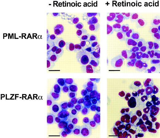 Fig. 4. Cells immortalized by PML-RAR or PLZF-RAR undergo granulocytic maturation in response to RA. Wright Giemsa stain of cytospin preparations made from cells grown in the absence (left) or in the presence (right) of RA (1 μmol/L) for 5 days. Bar = 20 μm.