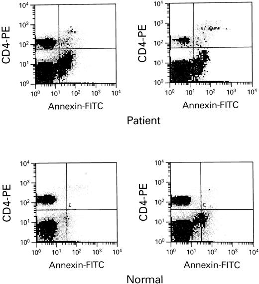 Fig. 2. HIV-infected persons with undetectable viral loads still demonstrate excessive apoptosis when compared with normal controls. Ten HIV patients receiving combination antiviral therapy with a protease inhibitor combination demonstrated normal Fas-R and ICE expression, but excessive apoptosis when compared with 6 normal controls. Scattergrams of apoptotic cells are seen above form-selected HIV-infected patients and normals.