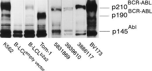 Fig. 3. EBV-transformed B-LCL, from the anti b2a2 peptide T-cell donor, transfected with full-length BCR-ABLb2a2express p210 BCR-ABL protein, as determined by anti-ABL immunoblot, whereas cells transfected with an empty PDR2 vector do not. K562 and Tom-1 were used as positive controls for p210BCR-ABL and p190BCR-ABL, respectively. Allogeneic HLA-DR–matched BCR-ABLb2a2 RT-PCR-positive leukemic cells from CML patients similarly express p210BCR-ABL as shown for UPN 5831869, 3939610, and 3886117. BV173 was used as a p210b2a2-positive (but p145ABL-negative8) control.