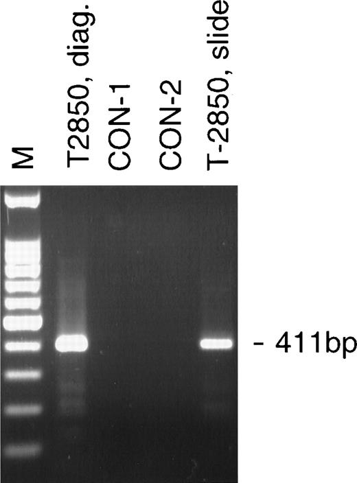 Fig. 2. Analysis of the AML-1-TEL translocation in a bone marrow smear 8 years and 9 months before diagnosis of leukemia. The 411-bp heminested AML-1-TEL PCR product was amplified from 10 ng of diagnostic DNA from T-2850 (T-2850, diag.) and 4 ng of DNA isolated from a stored bone marrow smear prepared 8 and a half years before diagnosis (T-2850, slide). Lanes containing 50 ng of DNA from normal controls (CON-1, CON-2) were negative.