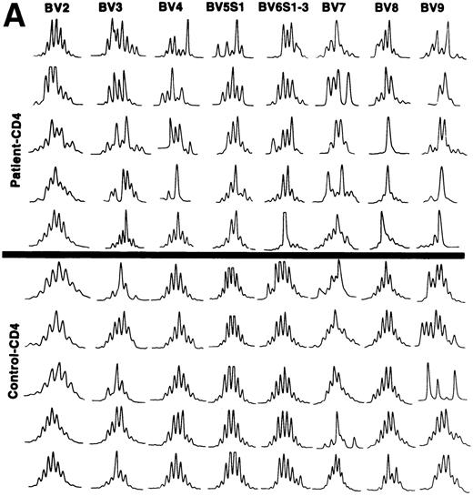 Fig. 3. (A) CDR3 length polymorphism in CD4 T cells of CLL patients expressing TCRBV 2, 3, 4, 5 S1, 6 S1-3, 7, 8, and 9 genes and control donors. Results of five individuals are shown. (B) CDR3 length polymorphism in CD8 T cells of CLL patients expressing TCRBV 2, 3, 4, 5 S1, 6 S1-3, 7, and 8 genes and control donors. Results of five individuals are shown.