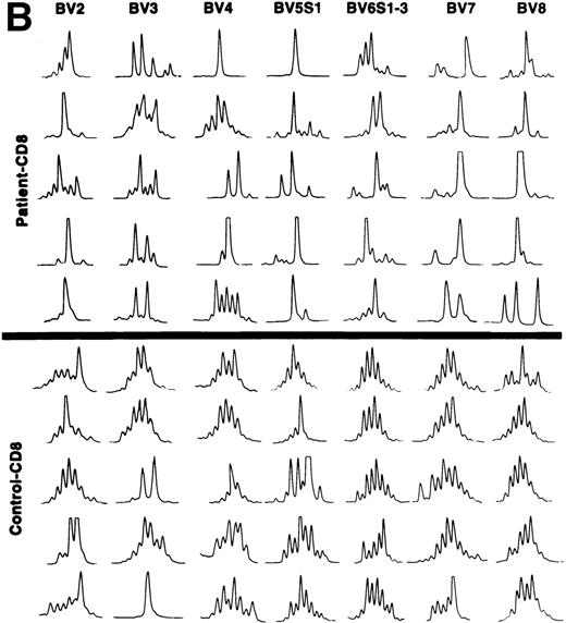 Fig. 3. (A) CDR3 length polymorphism in CD4 T cells of CLL patients expressing TCRBV 2, 3, 4, 5 S1, 6 S1-3, 7, 8, and 9 genes and control donors. Results of five individuals are shown. (B) CDR3 length polymorphism in CD8 T cells of CLL patients expressing TCRBV 2, 3, 4, 5 S1, 6 S1-3, 7, and 8 genes and control donors. Results of five individuals are shown.