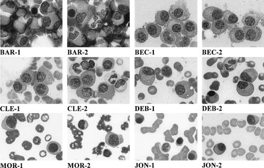 Fig. 1. Morphology of myeloma cells on May-Grünwald-Giemsa–stained bone marrow smears (original magnification × 1,000). Each patient is designated by initials, and 2 micrographs per patient are shown (numbered 1 and 2).