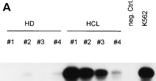 Fig. 4. (A) Expression of bFGF-specific mRNA. PBMC from HDs (n = 4) and patients suffering from HCL (n = 4) were subjected to RNA isolation immediately after separation by gradient centrifugation. After RT-PCR amplification using bFGF-specific primers and Southern blotting, positive reactions were visualized by hybridization with a DIG-labeled bFGF cDNA probe followed by autoradiography. Negative control: no cDNA added; K562 mRNA served as positive control. In parallel experiments, β-actin expression was analyzed by RT-PCR to ensure that identical amounts of cDNA are used (not shown). (B) Synthesis of bFGF protein. PBMC derived from HCL patients (n = 3) and HD (n = 3) were analyzed for intracellular bFGF. A total of 2 × 106 cells were lysed and bFGF was determined by ELISA. Data are shown as mean values (HD, 7 pg/mL; HCL, 420 pg/mL). (C) Activation of bFGF-specific mRNA. PBMC from HDs (n = 2) and HCL patients (n = 2) were cultured for 48 hours in medium or stimulated with either PWM (10 μg/mL) or TPA (10 ng/mL) + Ca-Ip A23187 (10 ng/mL) (TPA+Ca-Ip). After RNA isolation, RT-PCR, Southern blotting, and hybridization with a DIG-labeled bFGF, cDNA-positive reactions were visualized by autoradiography (a). K562 mRNA served as positive control. (b) Shows results of β-actin–specific RT-PCR.