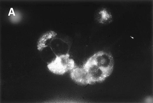Fig. 6. Double-immunofluorescence staining of PBMC from an HCL patient. Cell smears were fixed in acetone and incubated with a Cy3-labeled mouse anti-CD11c MoAb and a mouse anti-bFGF MoAb followed by the TS amplification system (see Materials and Methods). Green (A, anti-bFGF) and red (B, anti-CD11c) fluorescent signals from the same field were recorded sequentially. Experiments using isotype control antibodies or PBMC from an HD were negative (not shown).